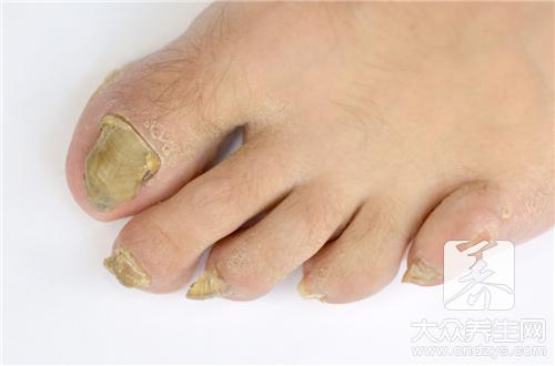 治疗灰指甲的偏方
